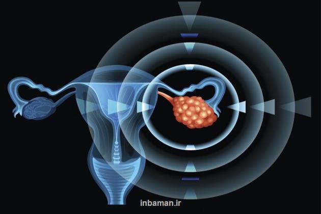 ضرورت آگاهی از علایم و عوارض سندرم تخمدان پلی کیستیک برای جلوگیری از نتایج جدی آن