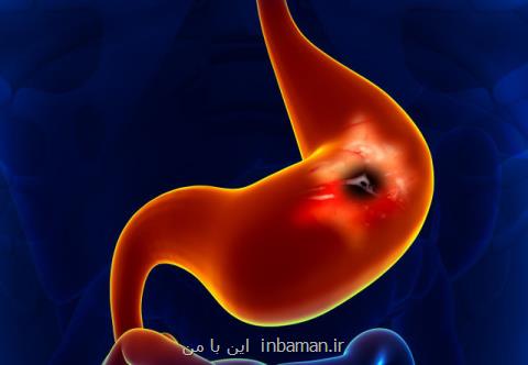 تشخیص سرطان مری و معده با آزمایش تنفس