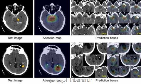 سیستم هوش مصنوعی خونریزی درون جمجمه ای را شناسایی می كند