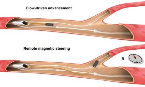 درمان اختلالات عصبی با حركت یك سیم در رگ های مغز
